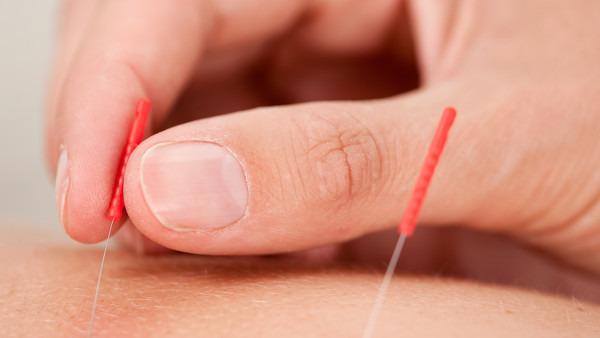 针刺疗法的禁忌症