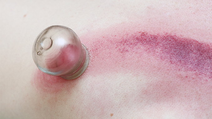 拔罐后皮肤颜色黑紫色怎么回事