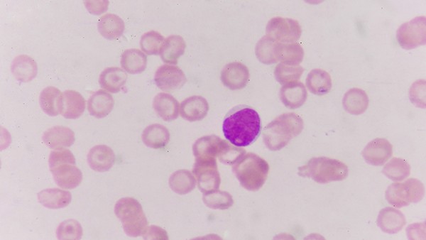 口腔癌的病因有哪些