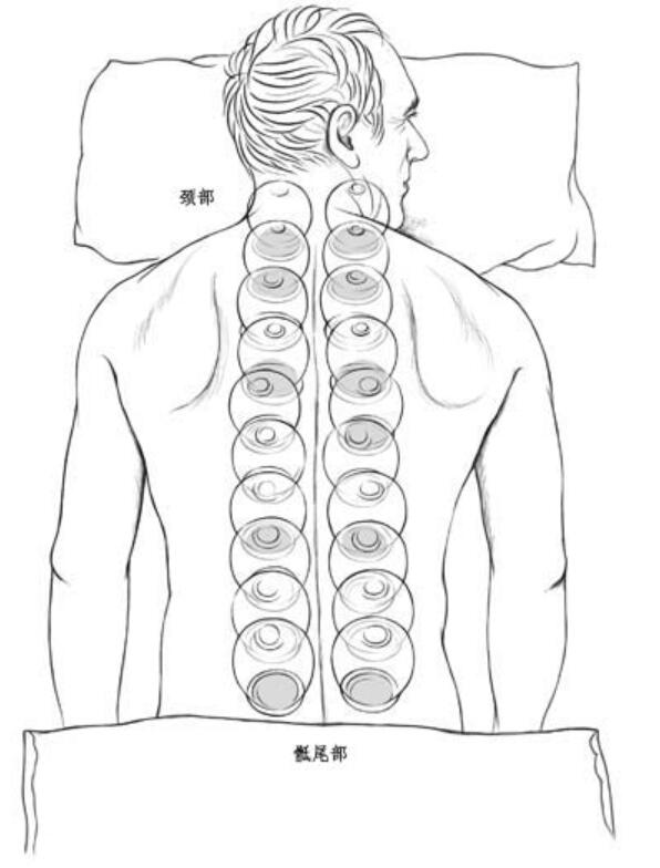 拔罐治疗中老年抑郁症