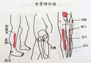 中医治疗坐骨神经痛的研究进展,坐骨神经痛的中医治疗方法