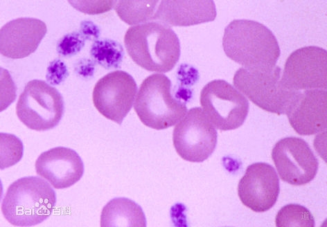 血小板减少如何治疗？民间验方牛皮胶疗效佳