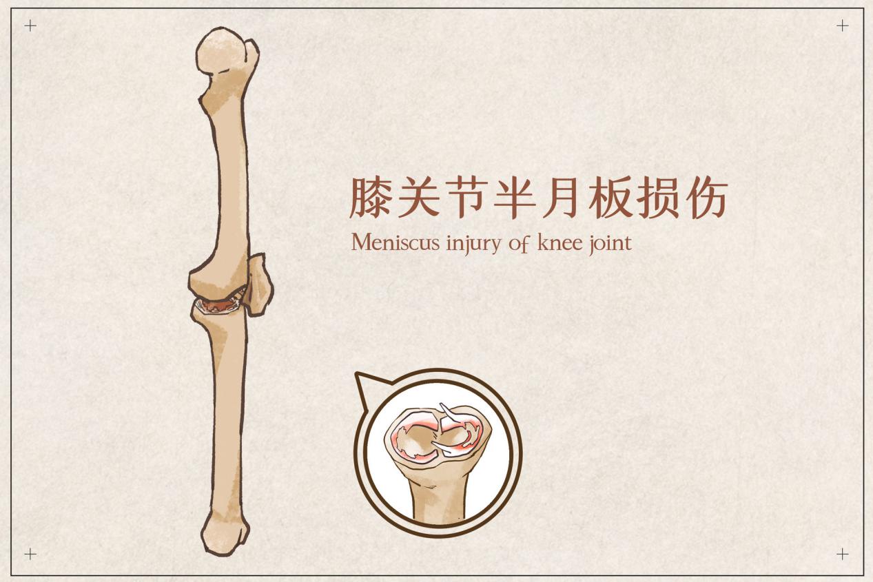半月板受损吃氨糖有用吗？呵护关节健康少不了它！